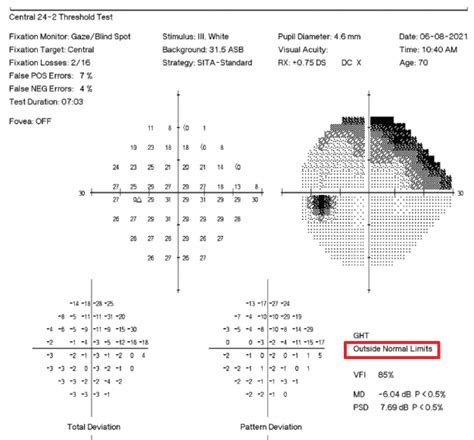 automated perimetry test results interpretation|An Update on Standard Automated Perimetry .